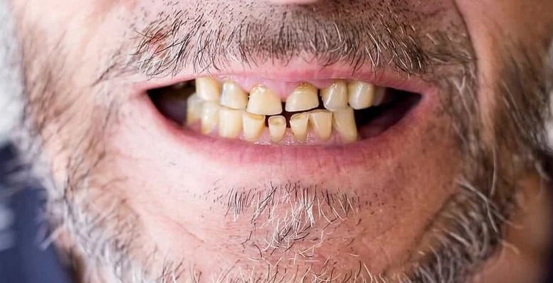 تآكل الأسنان : الأسباب وطرق العلاج